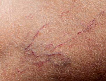 Spider Veins