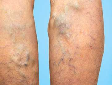 Varicose Veins